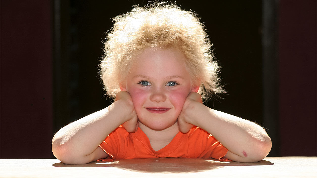 uncombable hair syndrome